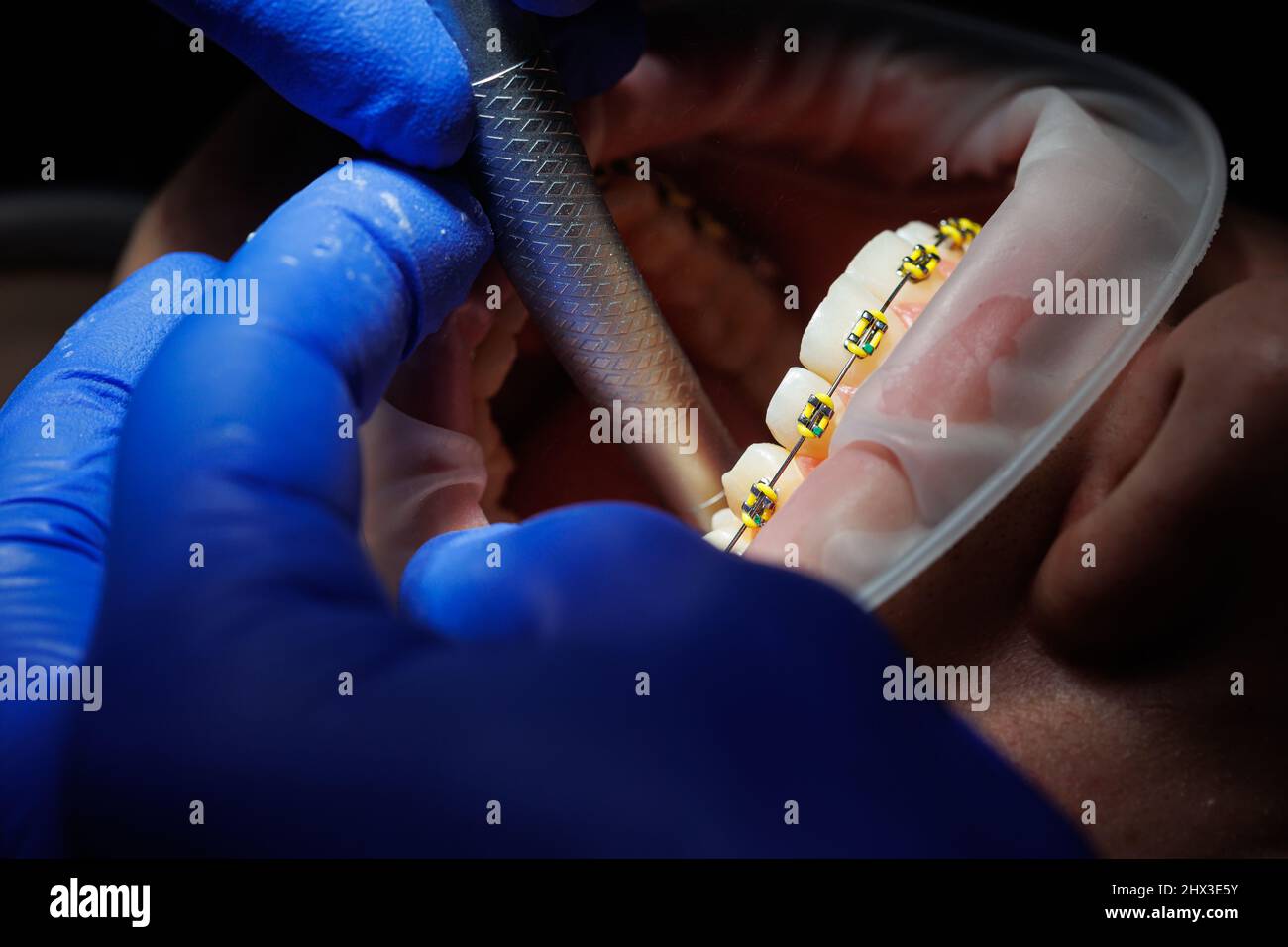Extender for teeth. Teeth of a woman with braces at a dentist