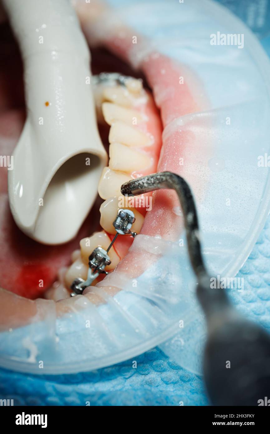 Top view of the process of brushing the patient's teeth. Teeth cleaning