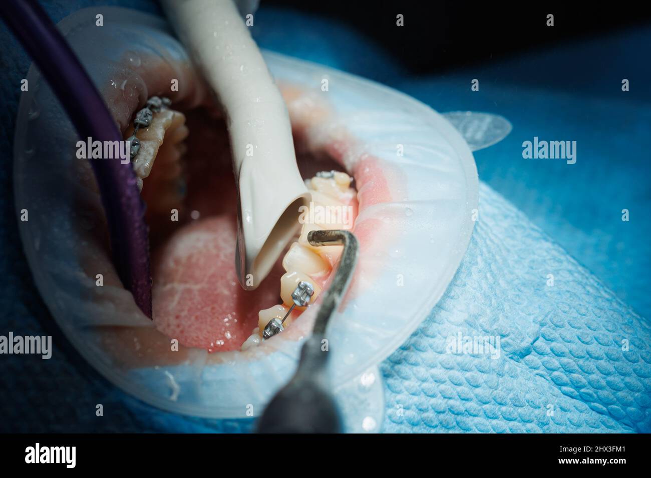Top view of the process of brushing the patient's teeth. Teeth cleaning