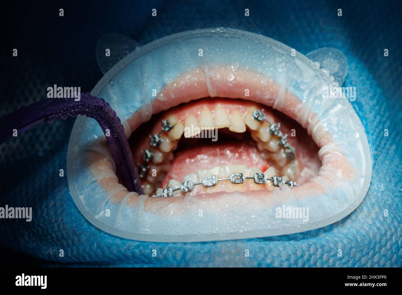 Top view of the process of brushing the patient's teeth. Teeth cleaning