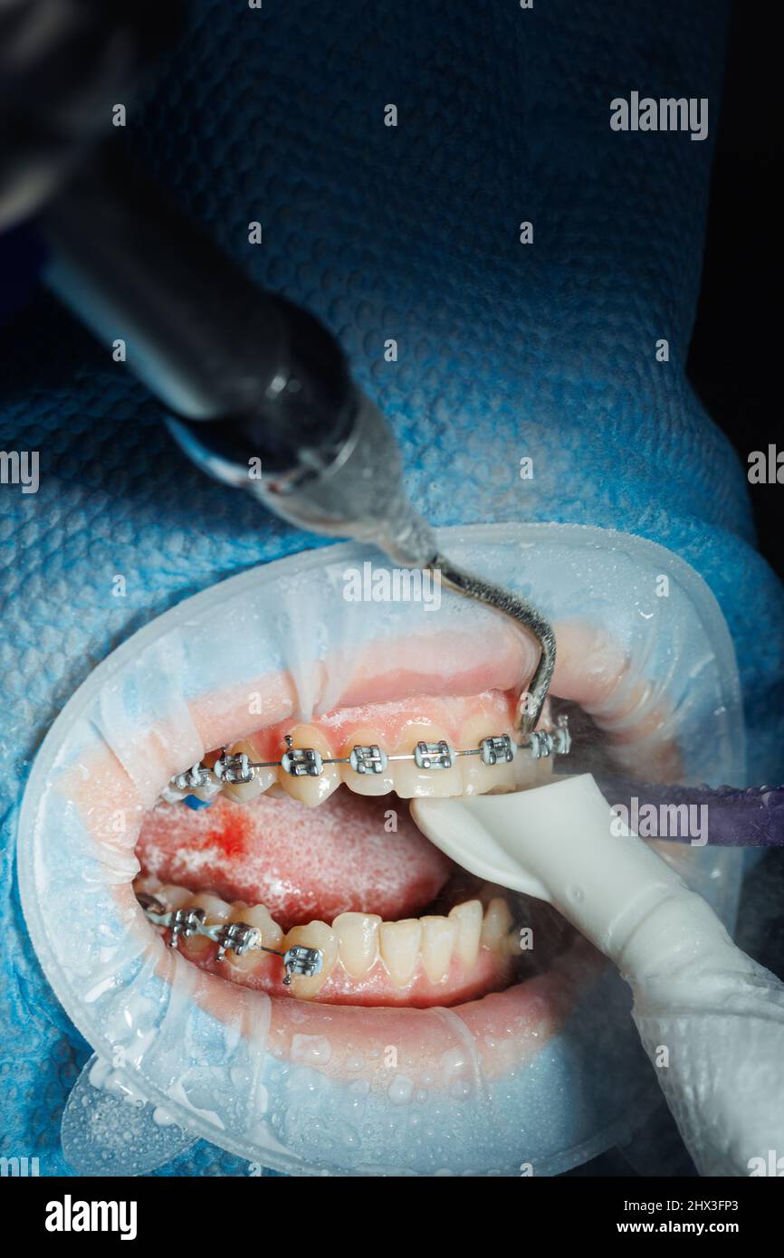 Top view of the process of brushing the patient's teeth. Teeth cleaning