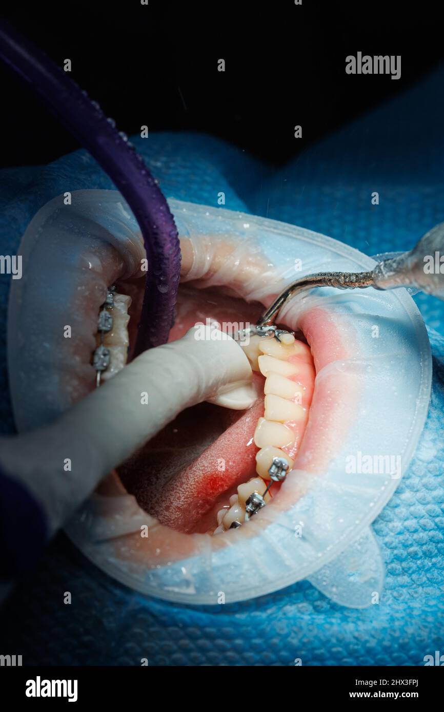 Top view of the process of brushing the patient's teeth. Teeth cleaning