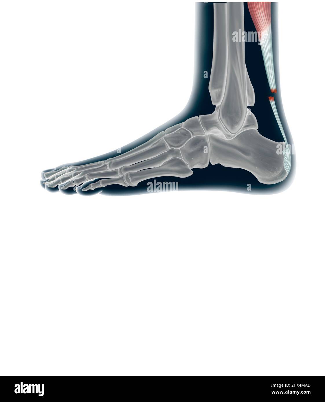 Achilles tendon rupture Stock Photo