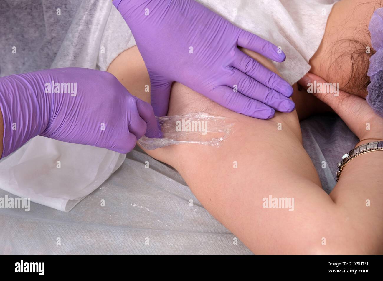 Sugaring hair removal concept. Process depilation of underarm girl with sugar paste in spa salon Stock Photo