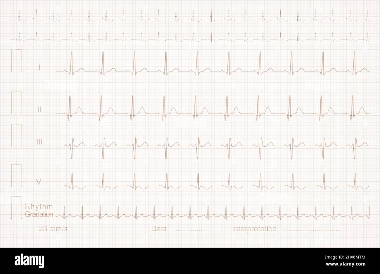 ECG (cardiogram) on the linear graph paper Stock Photo