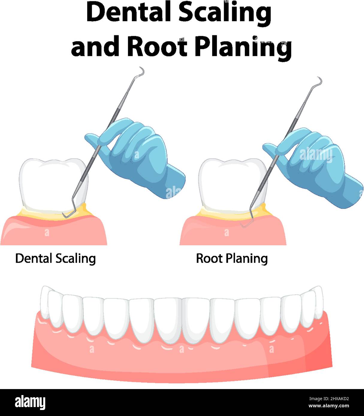 Infographic of human in dental scaling and root planing illustration Stock Vector