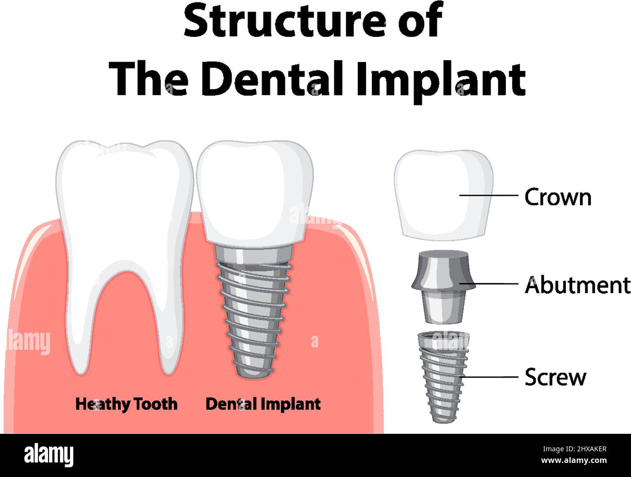 Infographic of human in structure of the dental implant illustration