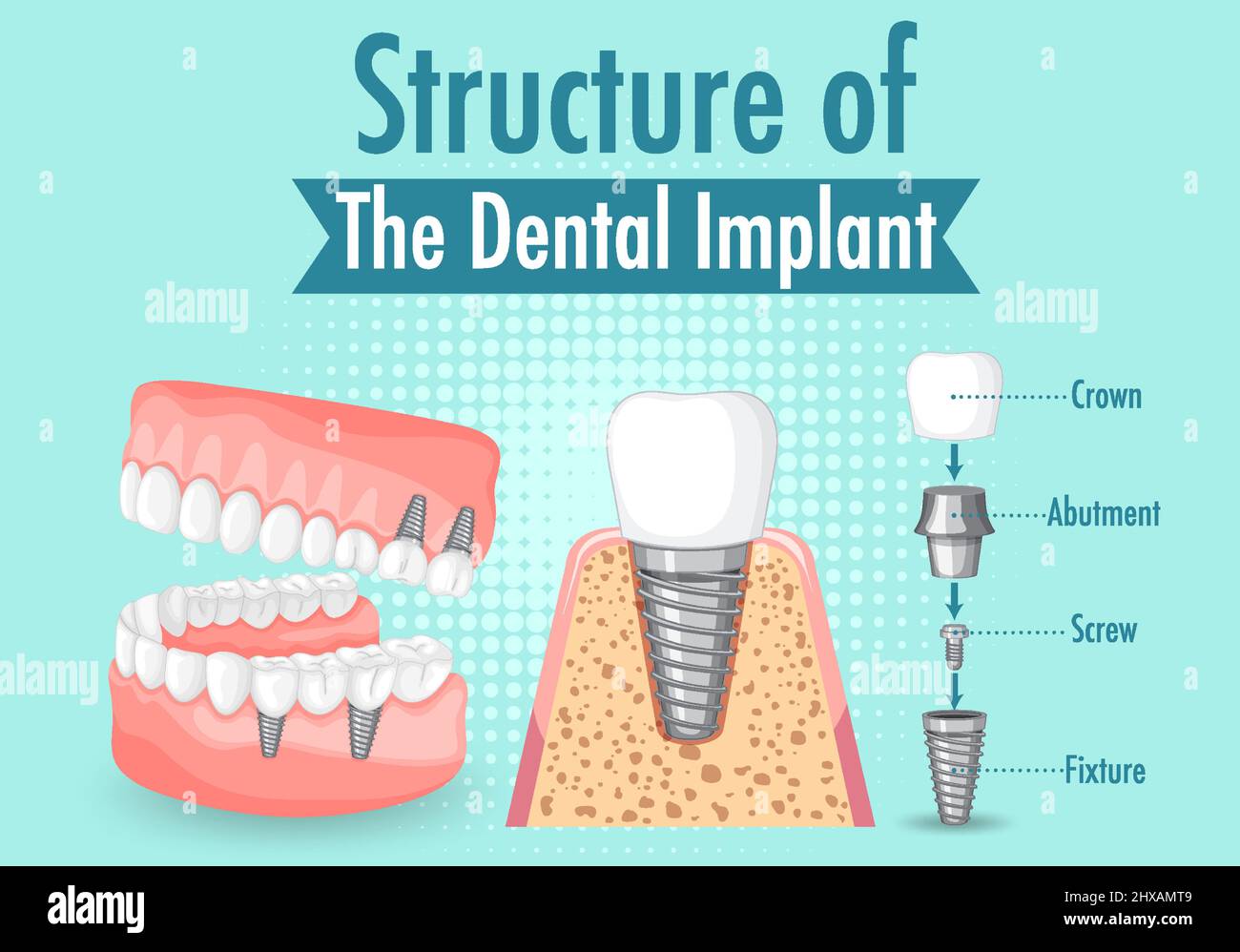 Infographic of human in structure of the dental implant illustration