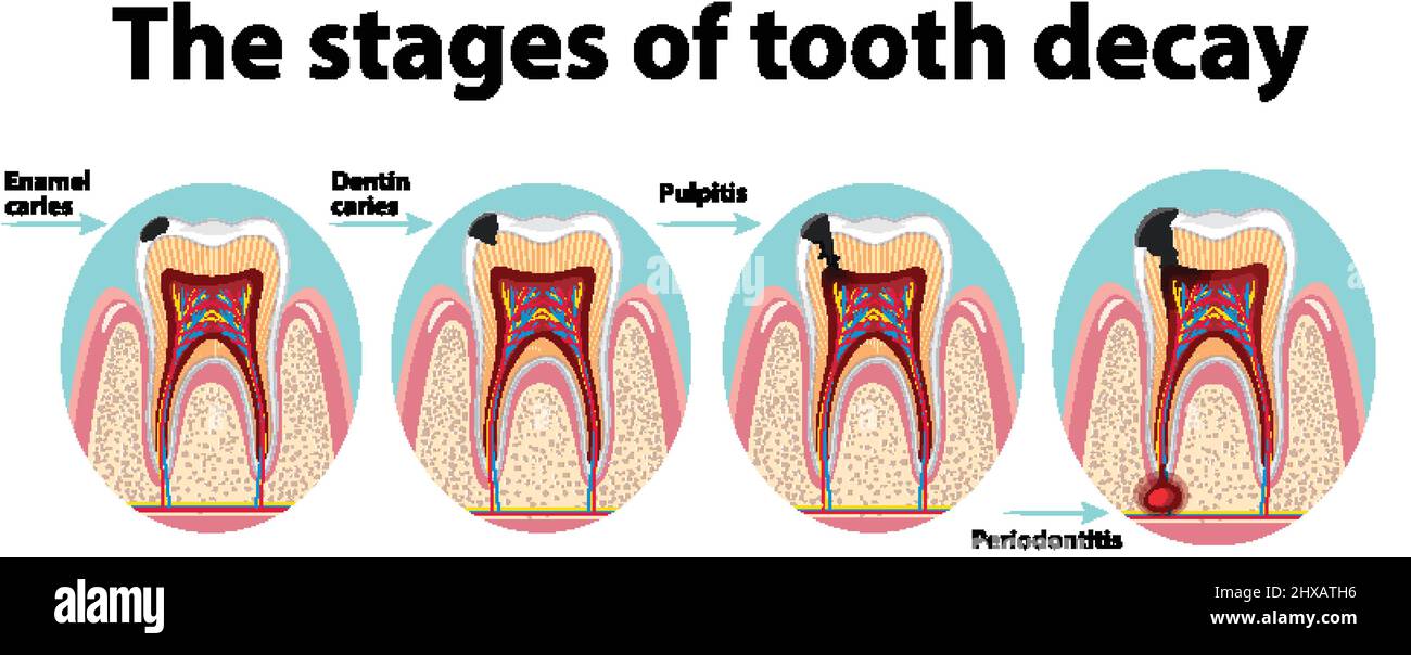 Infographic of human in the stages of tooth decay illustration Stock Vector