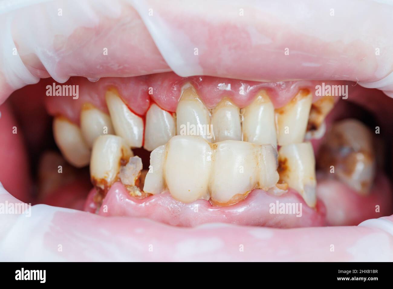 Spoiled teeth, poor dental hygiene, caries, Mouth disease. shattered teeth  Stock Photo - Alamy