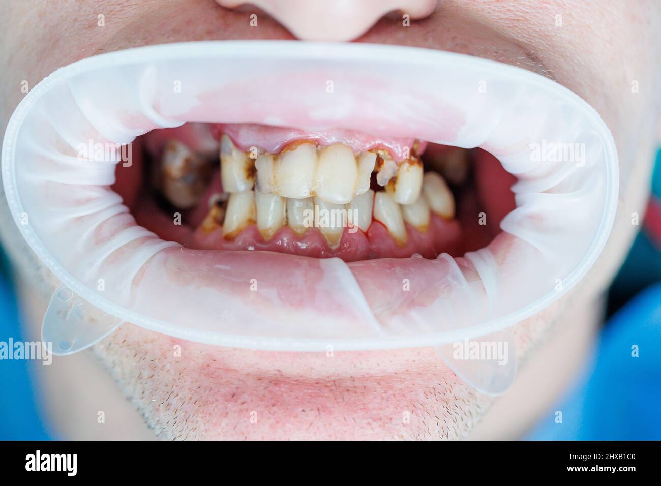Spoiled teeth, poor dental hygiene, caries, Mouth disease. shattered teeth  Stock Photo - Alamy