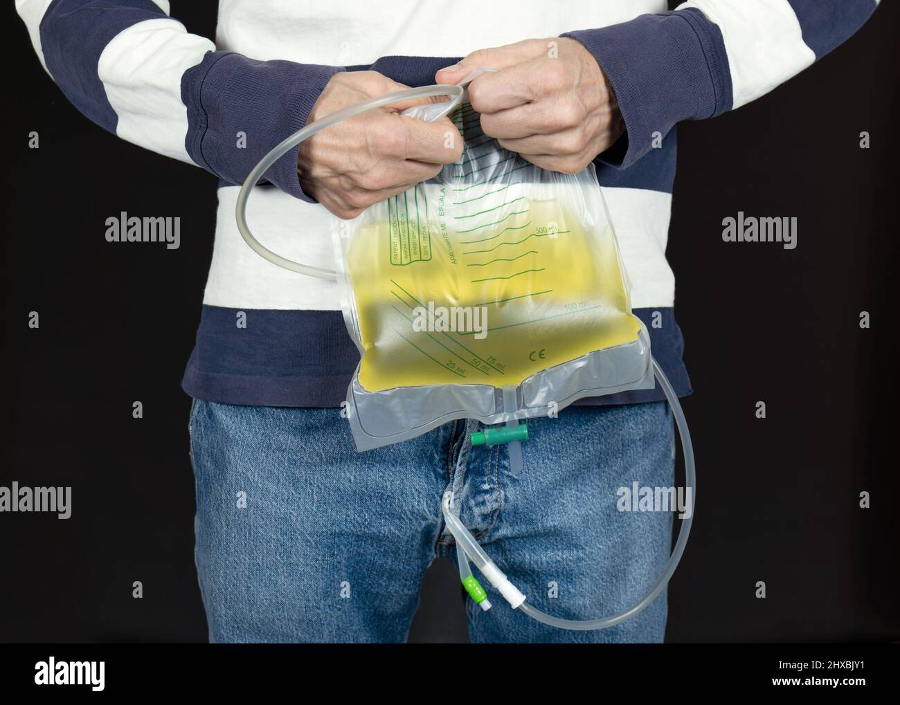Man in clothes holds a filled catheter bag with both hands.result from