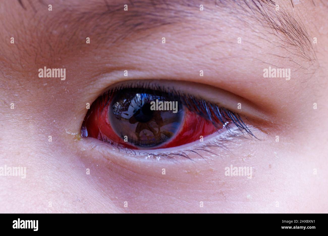 bloodshot eye of child after surgery for strabismus Stock Photo