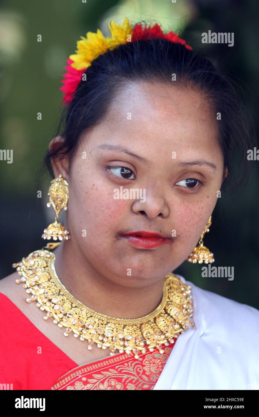 Dhaka, Bangladesh March 21, 2015 Down syndrome girl in Dhaka