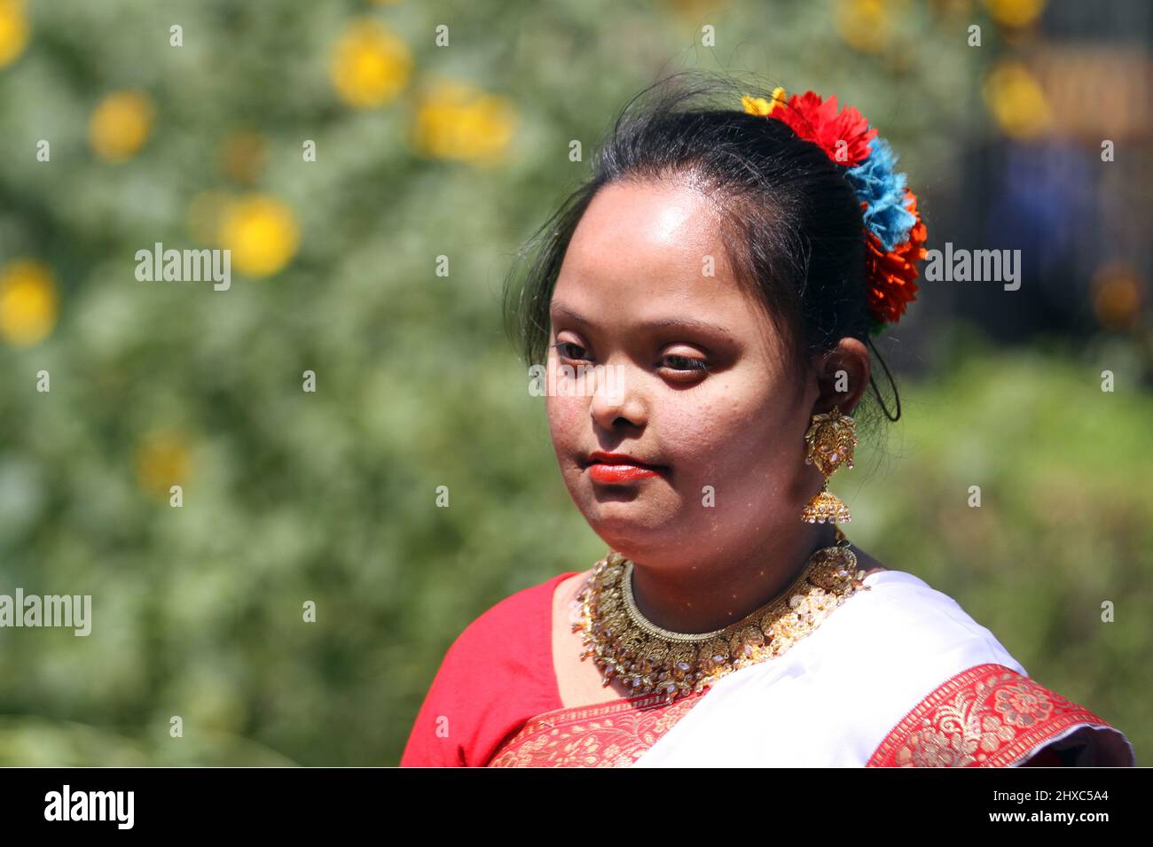 Dhaka, Bangladesh March 21, 2015 Down syndrome girl in Dhaka