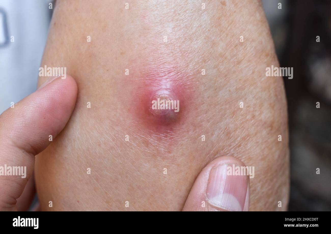 Large carbuncle or abscess at forearm of Asian Burmese male patient. Stock Photo