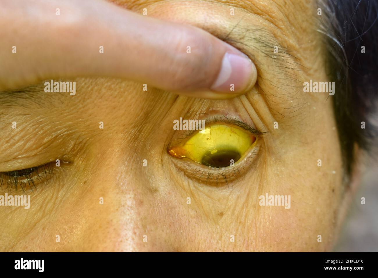 Deep jaundice in Asian male patient. Yellowish discoloration of skin