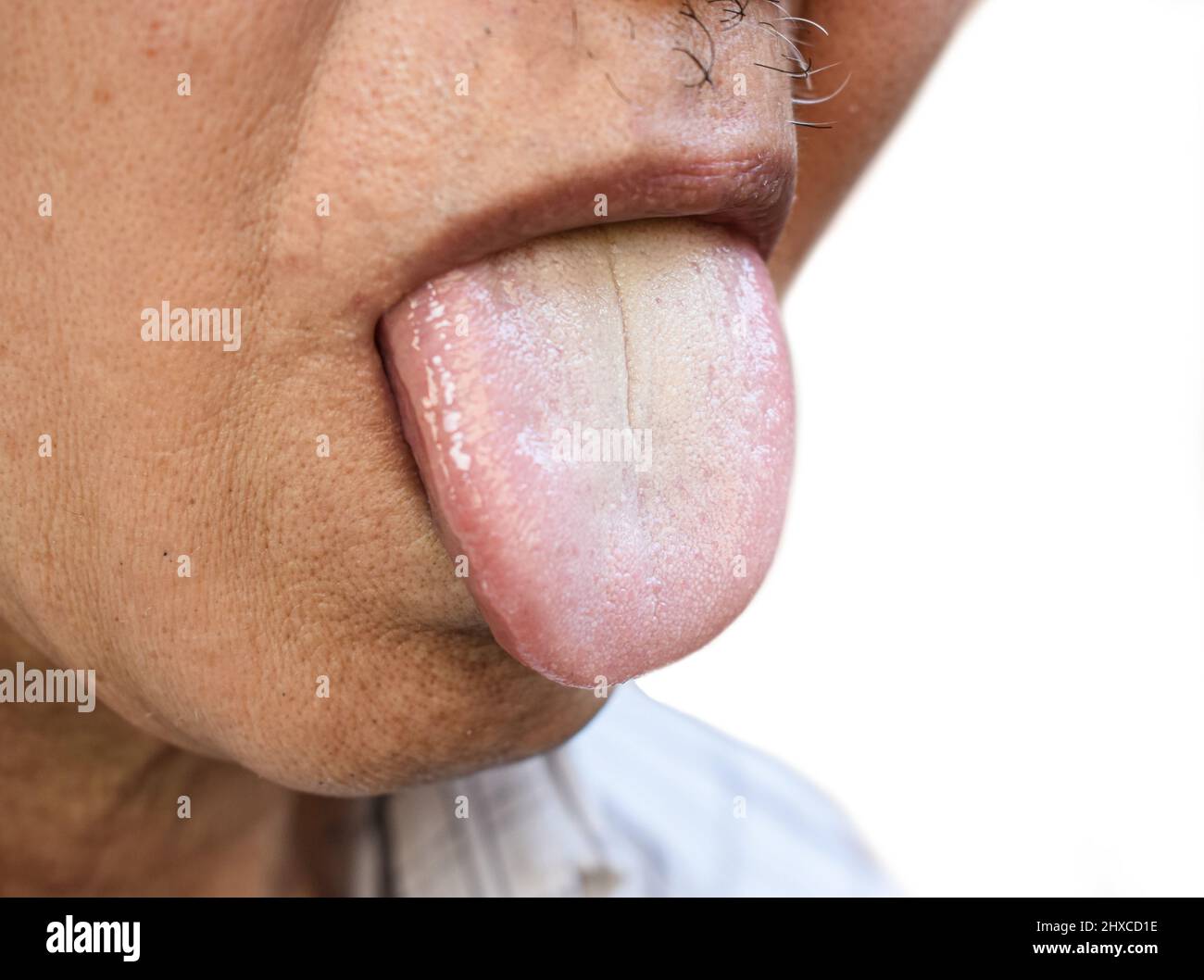 Coated tongue or white tongue of Asian, Chinese man. It appears with white layer when debris, bacteria and dead cells become lodged between enlarged p Stock Photo