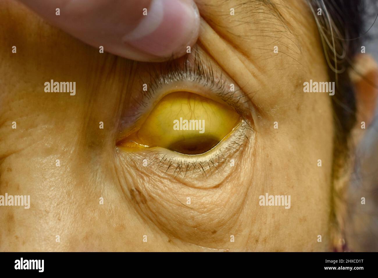 Deep jaundice in Asian female patient. Yellowish discoloration of skin and sclera. Hyperbilirubinemia. Acute hepatitis. Stock Photo