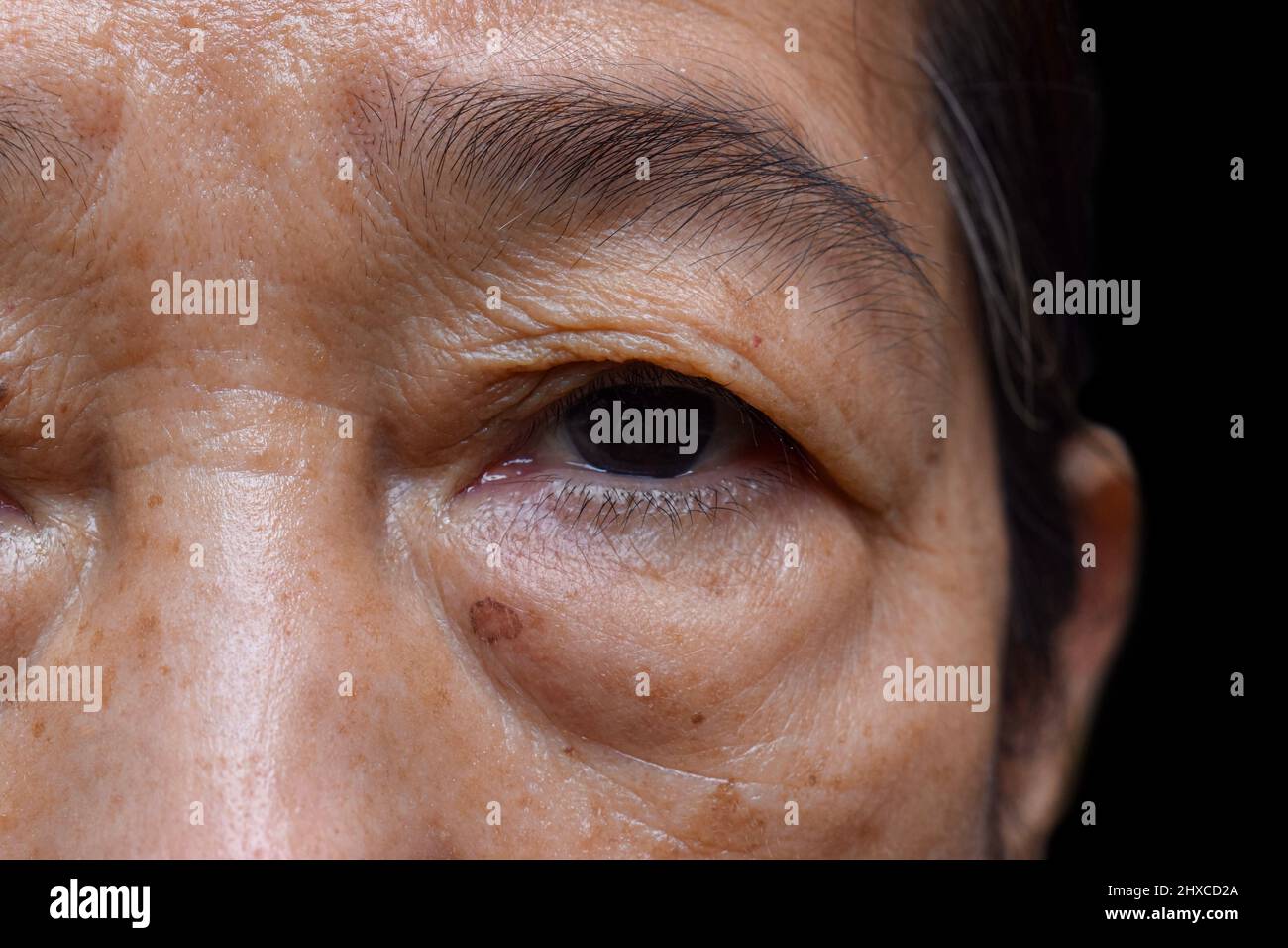 Prominent fat bag under eye of Asian elder woman. Closeup view. Stock Photo