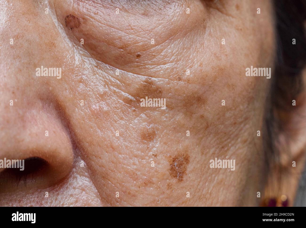 Small brown patches called age spots on face of Asian elder woman. They are also called liver spots, senile lentigo, or sun spots. Closeup view. Stock Photo