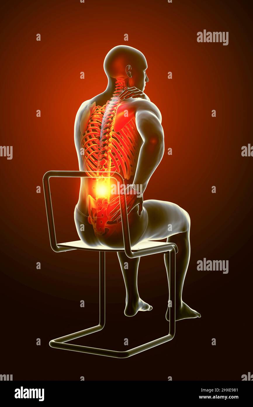 Back pain, conceptual illustration Stock Photo - Alamy