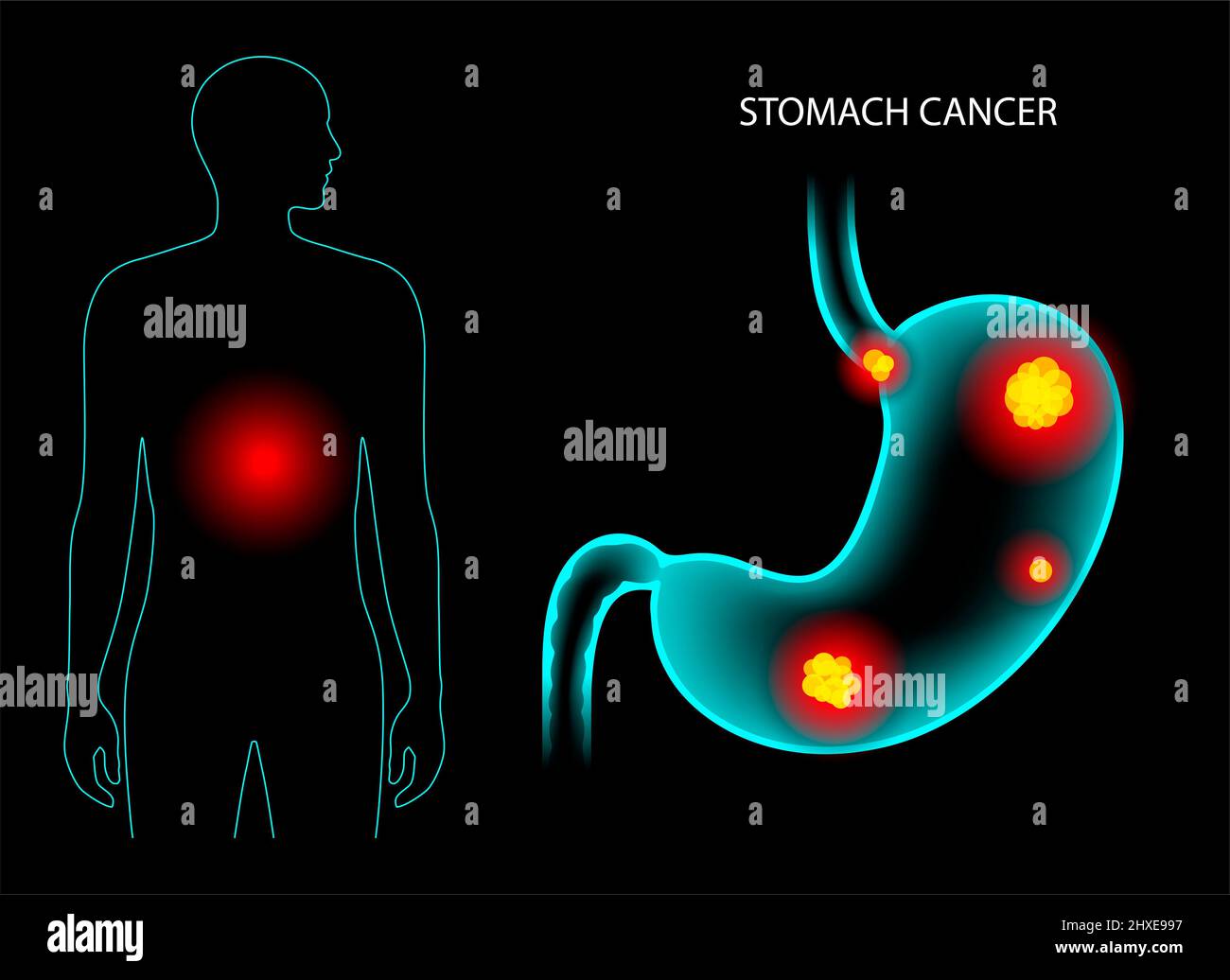 Stomach cancer, illustration Stock Photo