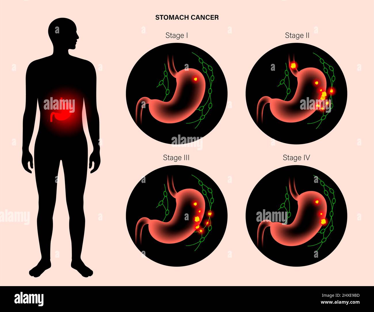 Stomach cancer, illustration Stock Photo