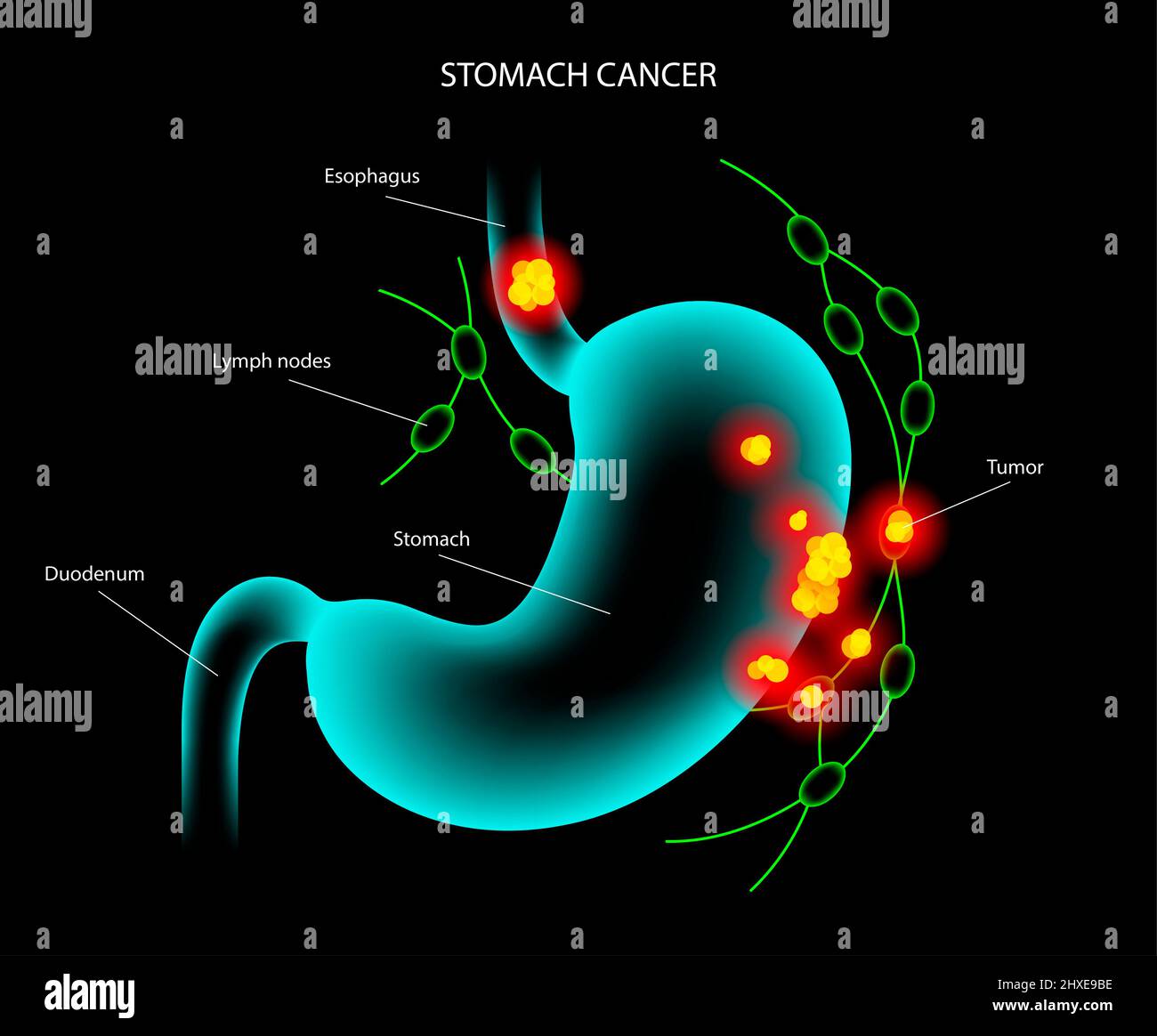 Stomach cancer, illustration Stock Photo