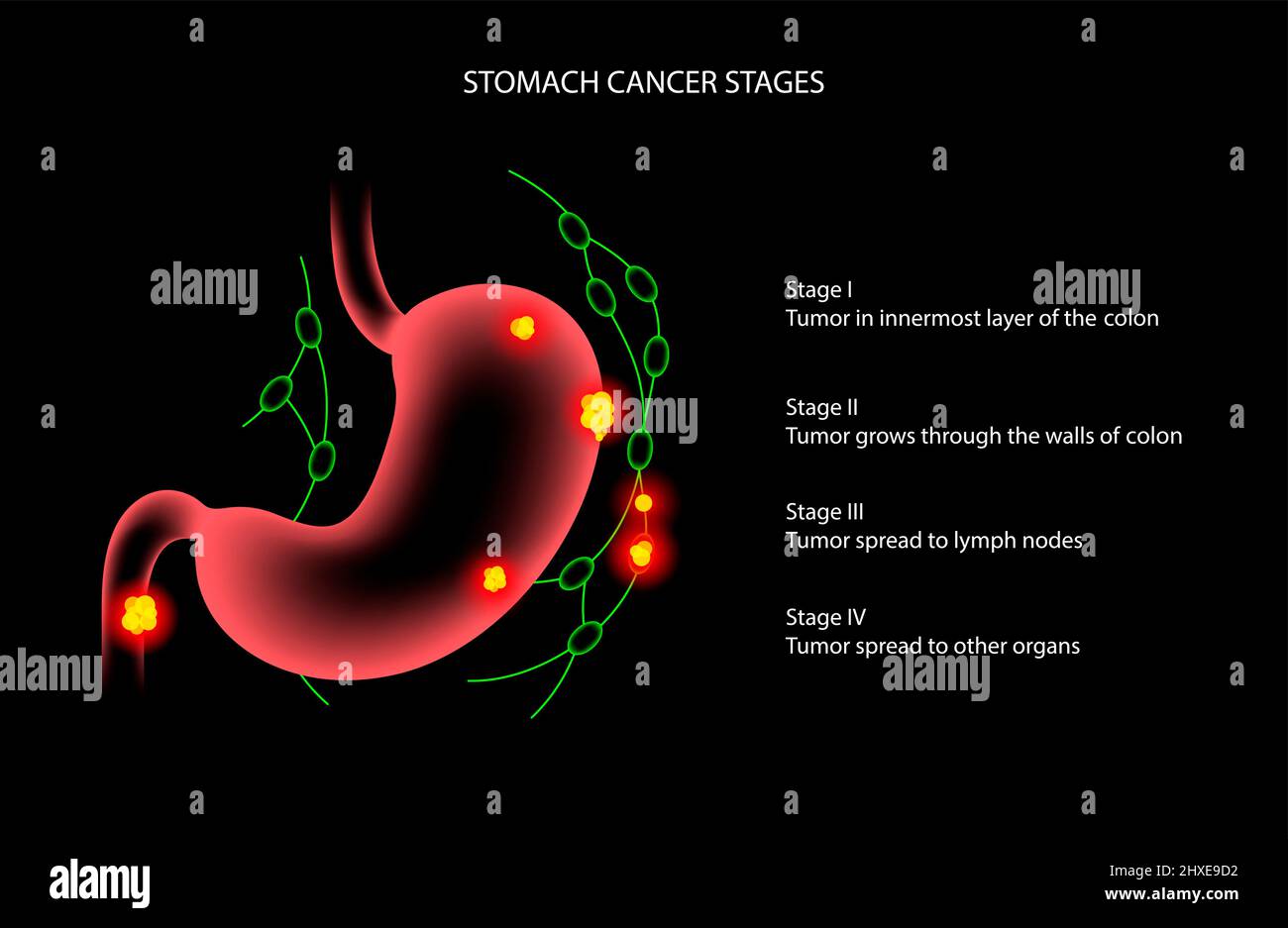 Stomach cancer, illustration Stock Photo