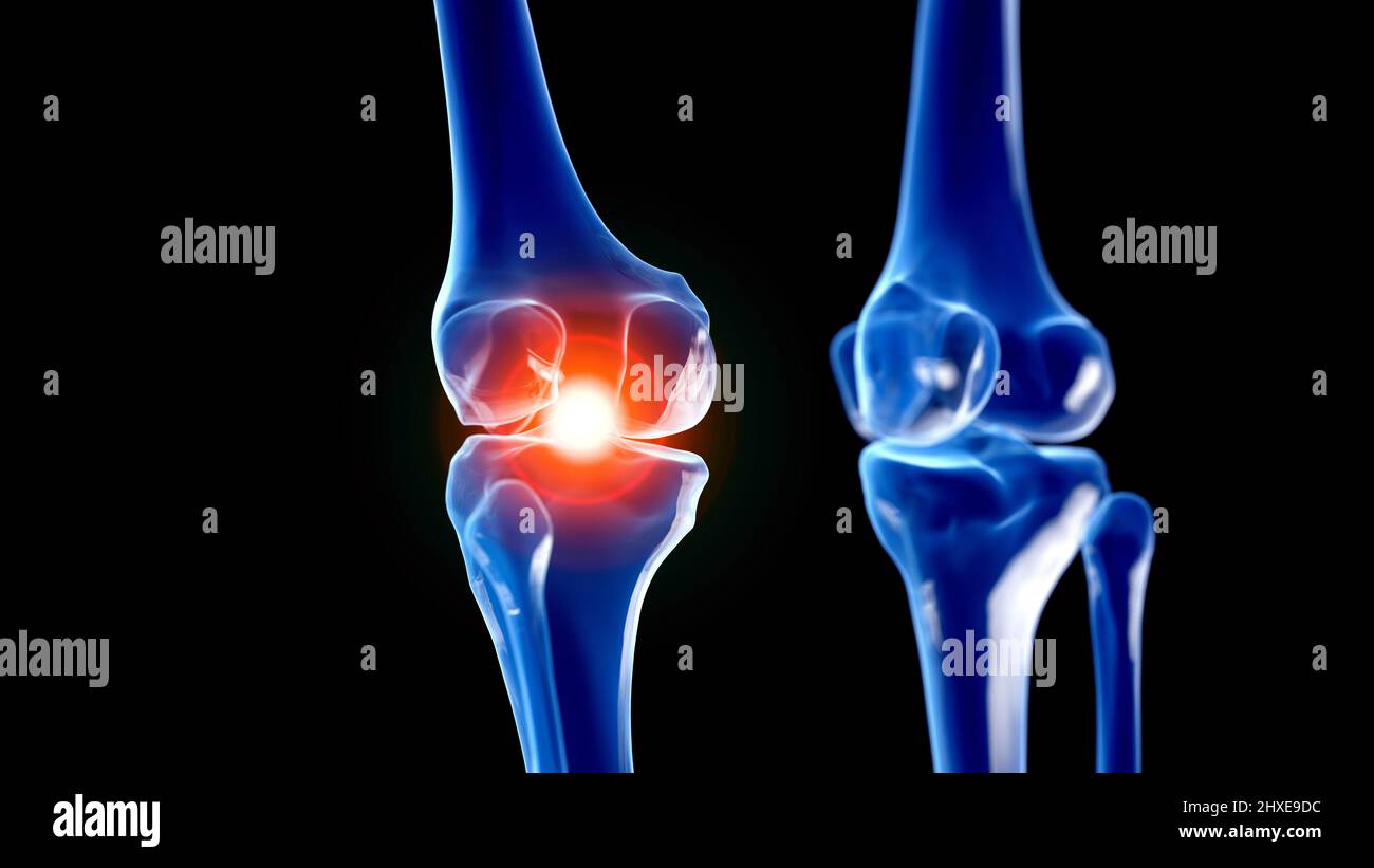 Painful knee joint, illustration Stock Photo Alamy