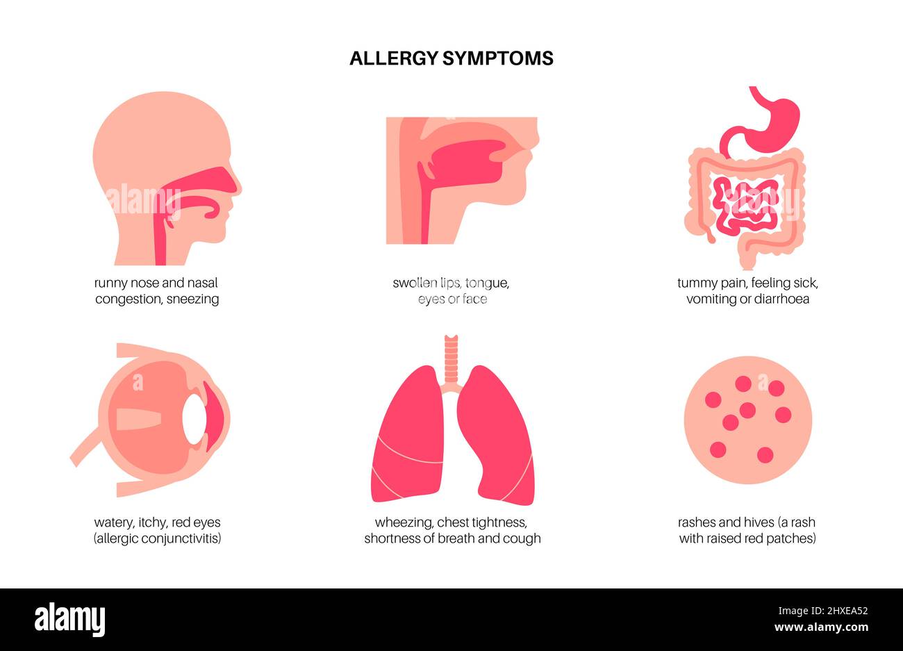 Allergy symptoms, conceptual illustration Stock Photo