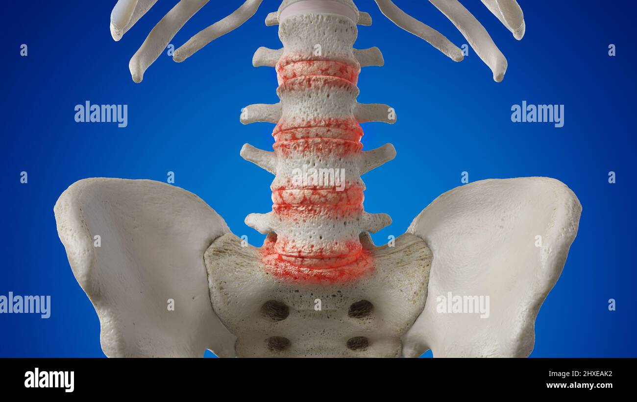 Arthritic lumbar spine, illustration Stock Photo