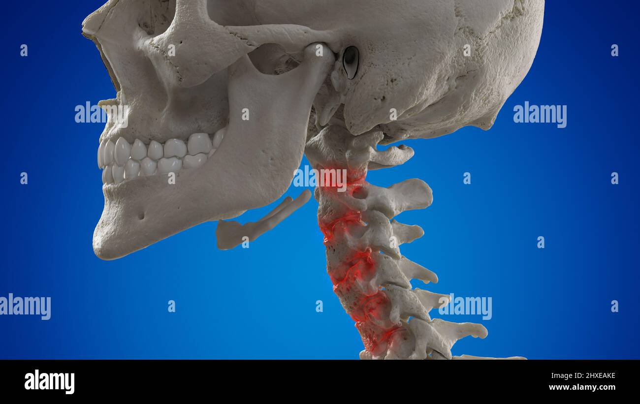 Arthritic cervical spine, illustration Stock Photo Alamy