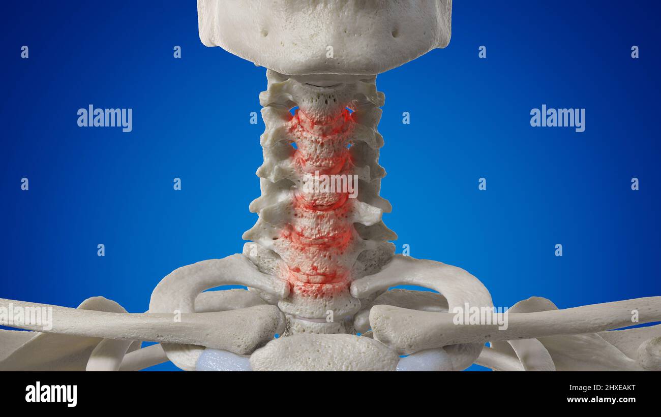Arthritic cervical spine, illustration Stock Photo Alamy