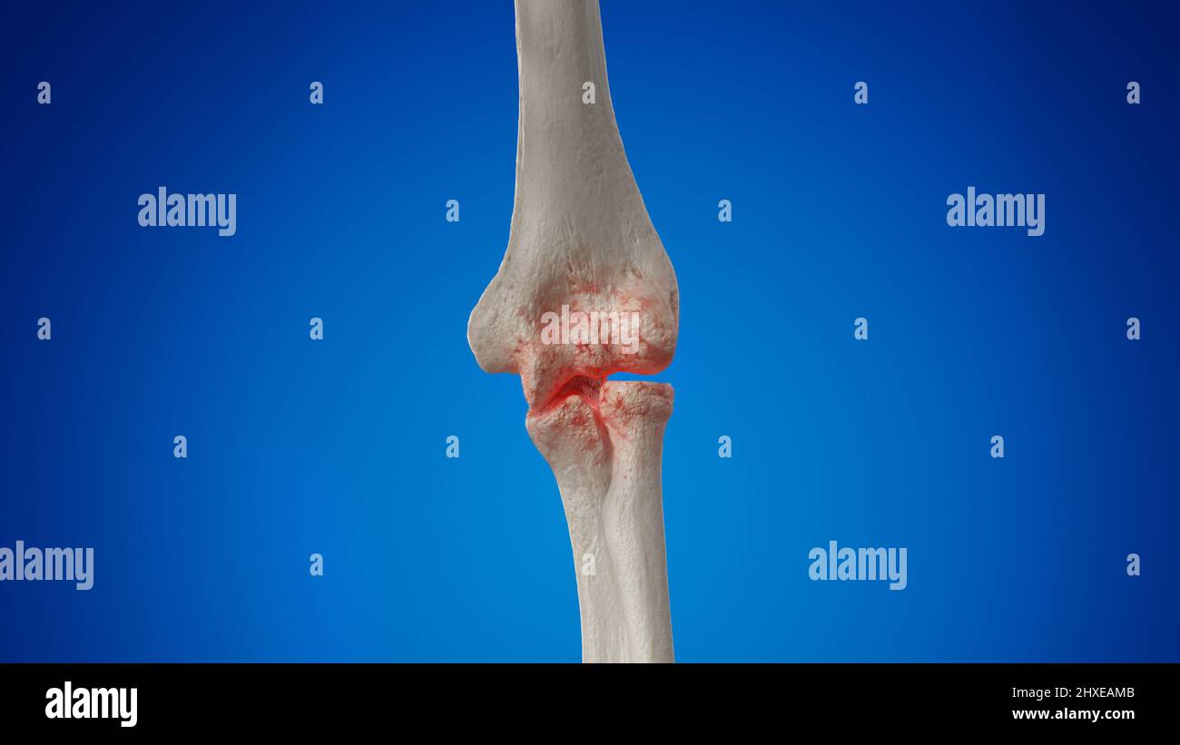 Arthritic elbow joint, illustration Stock Photo Alamy