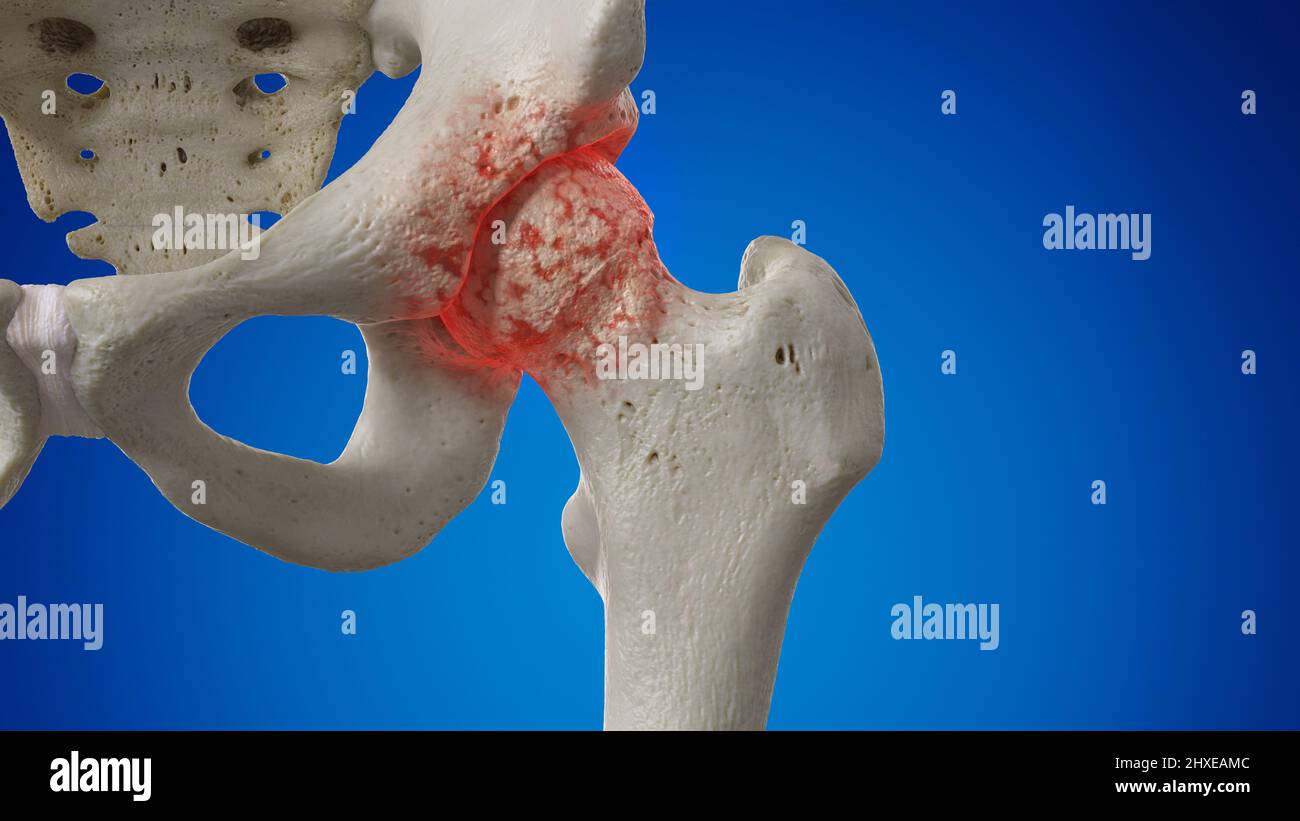 Arthritic hip joint, illustration Stock Photo Alamy