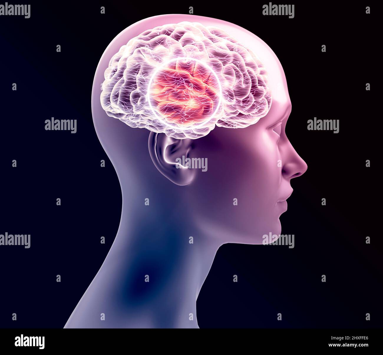 Woman and human brain seen in profile. X-rays. Degenerative disease, synapses and neurons, brain functioning. Stroke and cognitive problems. Parkinson Stock Photo