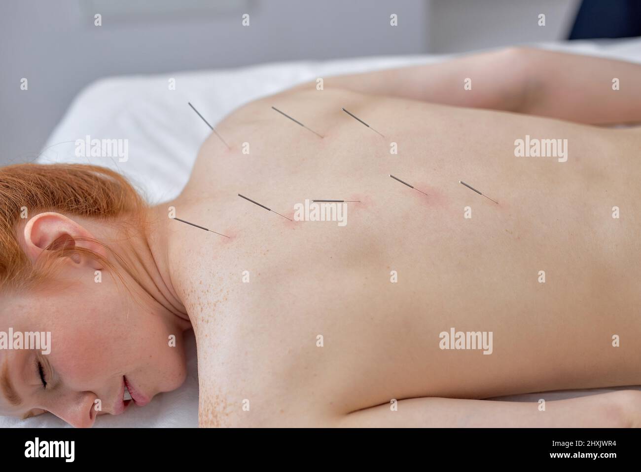 acupuncture therapy on back spine shoulders for woman client. female undergoing acupuncture treatment with a line of fine needles inserted into slim b Stock Photo