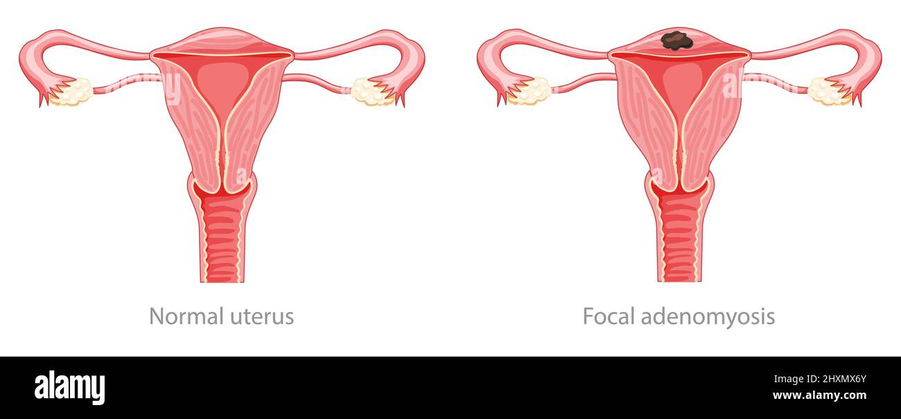Focal Adenomyosis Human anatomy Female Sick and normal reproductive system organs. Location scheme Cross section uterus, cervix, ovary, fallopian tube icon. Vector illustration isolated on white Stock Vector