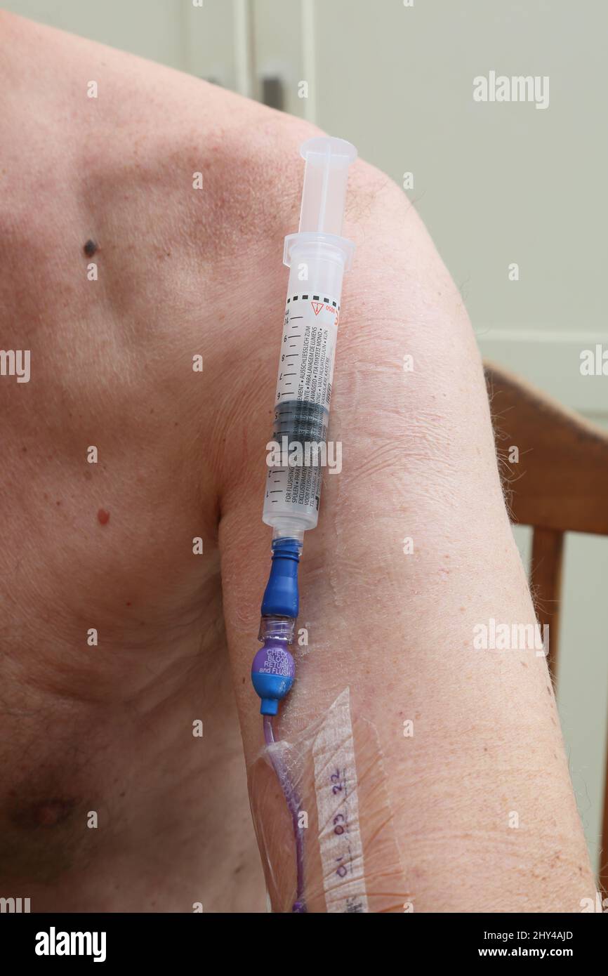 Solution for Flushing out the Picc Line (Peripherally Inserted Central Catheter) after Chemotherapy Session Stock Photo