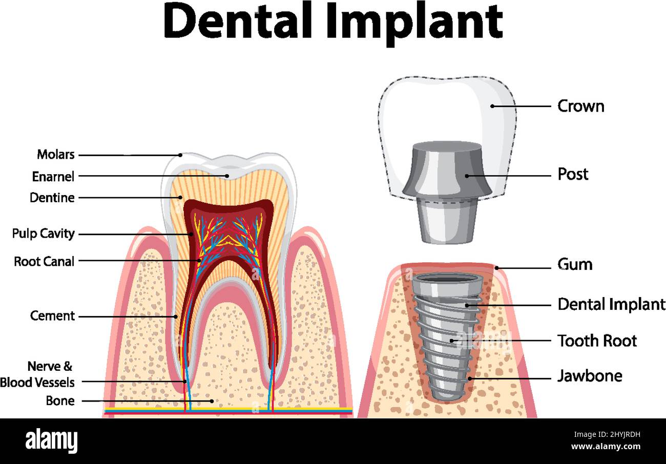 Infographic of human in structure of the dental implant illustration