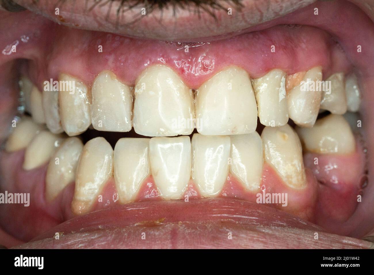 Cosmetic restoration of tooth Stock Photo Alamy