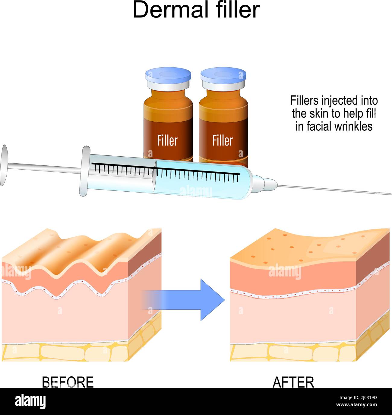 Dermal filler. Fillers injected into the skin to help fill in facial wrinkles. Cross section of the skin before and after injection. syringe Stock Vector
