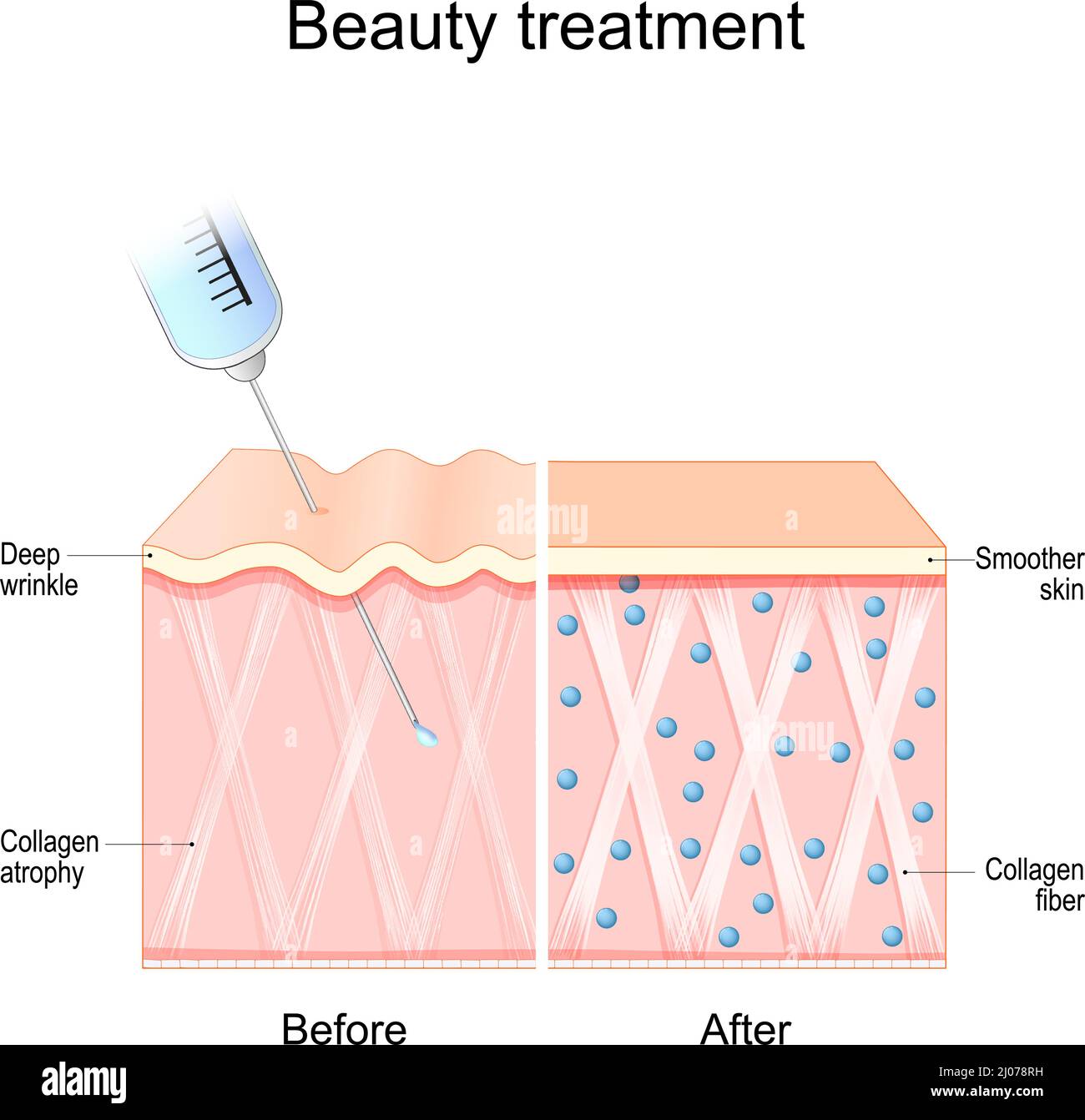 Beauty treatment. Human skin before and after procedure. Collagen atrophy and Deep wrinkle. Smoother skin after injection. Vector illustration Stock Vector