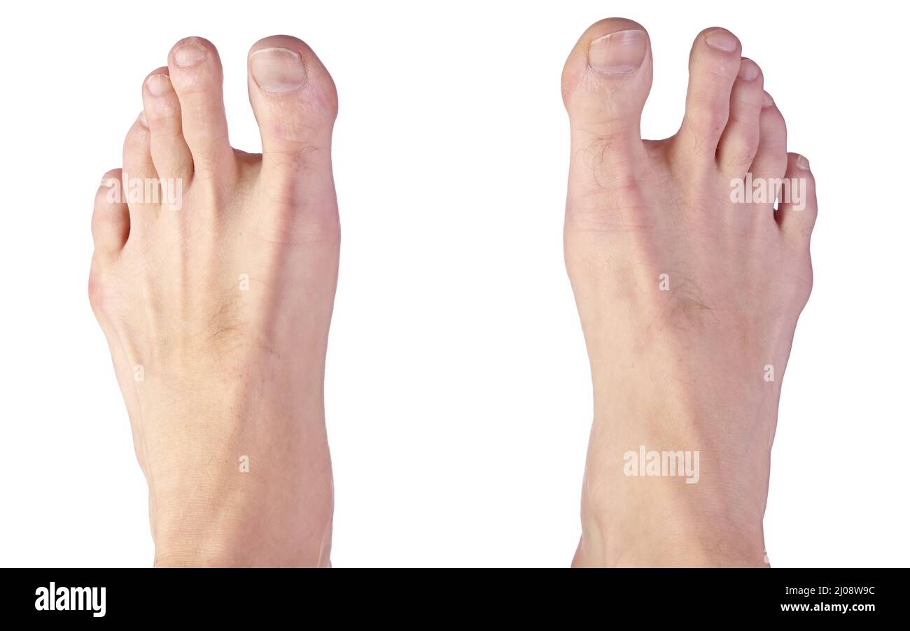 Close up of a Man's Feet Showing Sandal Gap Deformity, also known as Hallux Varus Stock Photo