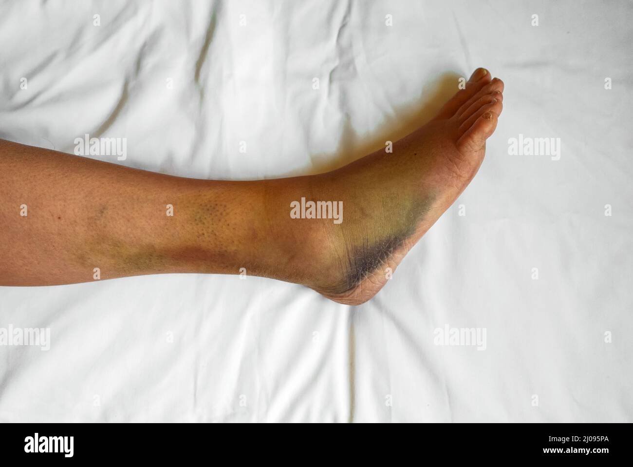 Female leg with bruises and swelling Stock Photo Alamy