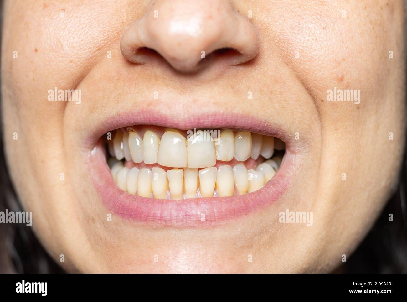 Gum retraction and dental implant Stock Photo Alamy