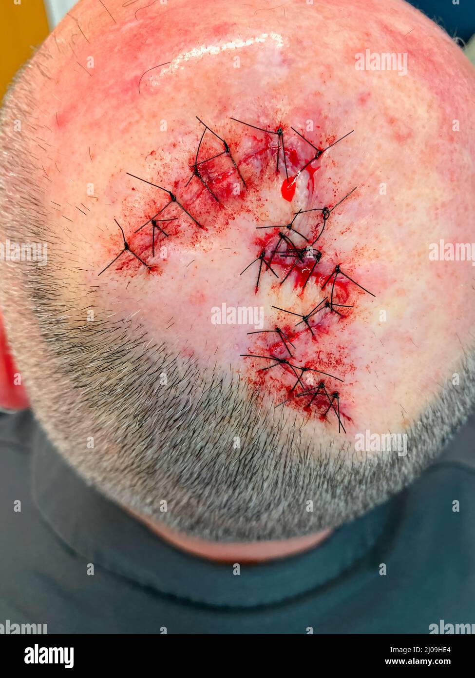 Close up view of Mohs surgery on scalp Stock Photo
