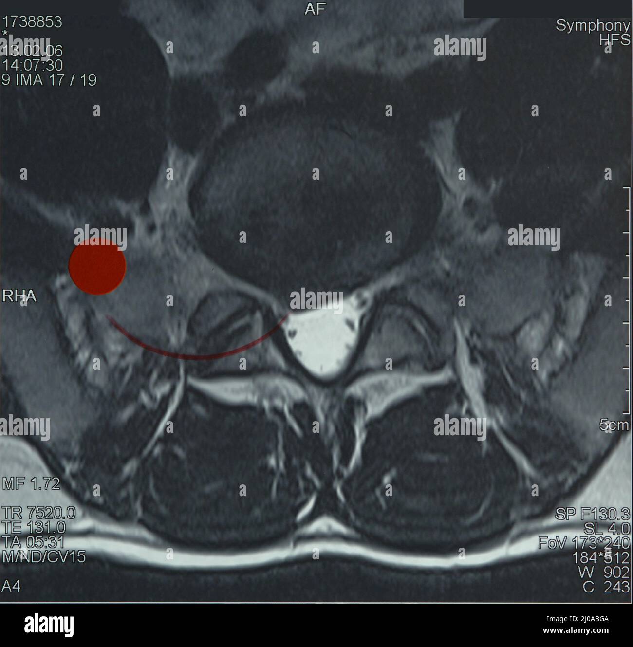 Mri lumbar spine hires stock photography and images Alamy
